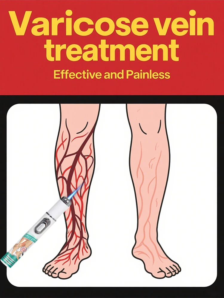 

Varicose vein treatment, eliminate leg swelling, pain disappears