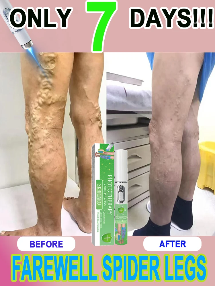 Say goodbye to varicose veins