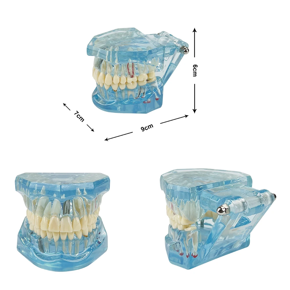 Modelo Dental de restauración de implantes dentales, puente de enseñanza, estudio de ciencia médica, modelo de análisis de enfermedades, materiales