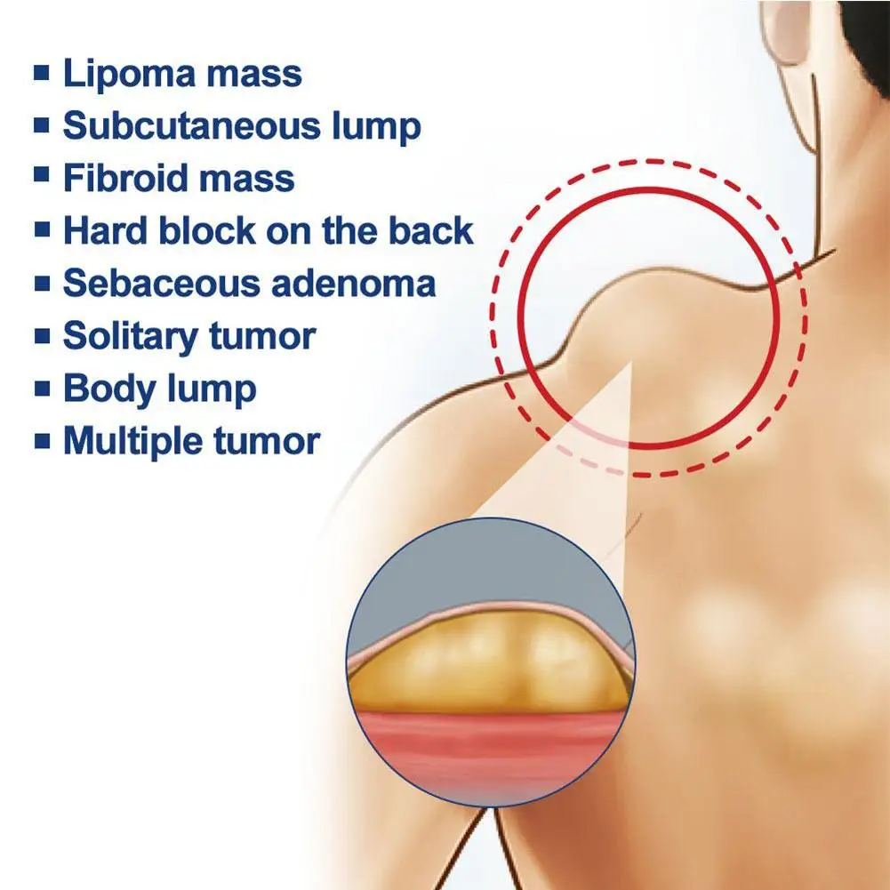 Pomada de labios para eliminar eficazmente los fibroides, crema corporal para disolución de grasa, fácil de usar