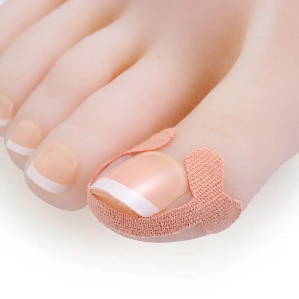 Pedicure patch Nail Toe Teratment unghie incarnite per decalcomanie dei piedi Paronychia Pedicure strumenti Pedicure Sticker strumento per la cura dei piedi