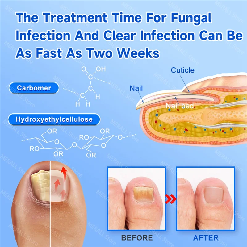 ABIT 2PCS Fungal Nail Laser Device Repair Fingernail Treatment Anti Fungus Infection Paronychia Onychomycosis Ingrown Toenail