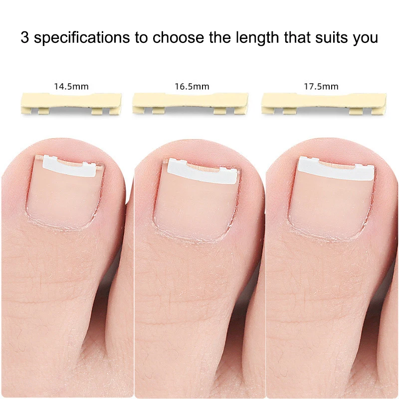 1PCS Ingrown Toenai…