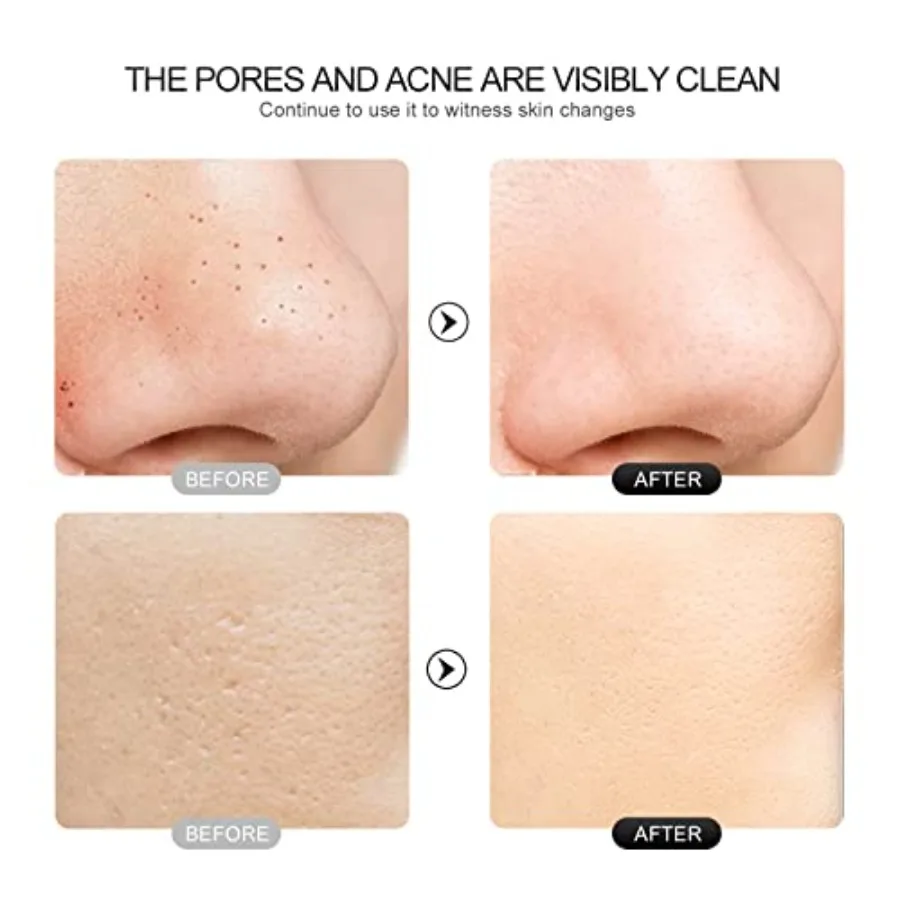 Espátula de pele para purificador facial, removedor preto com 4 modos, extrator de poros, espátula facial, limpeza profunda para cuidados com a pele facial, presente feminino