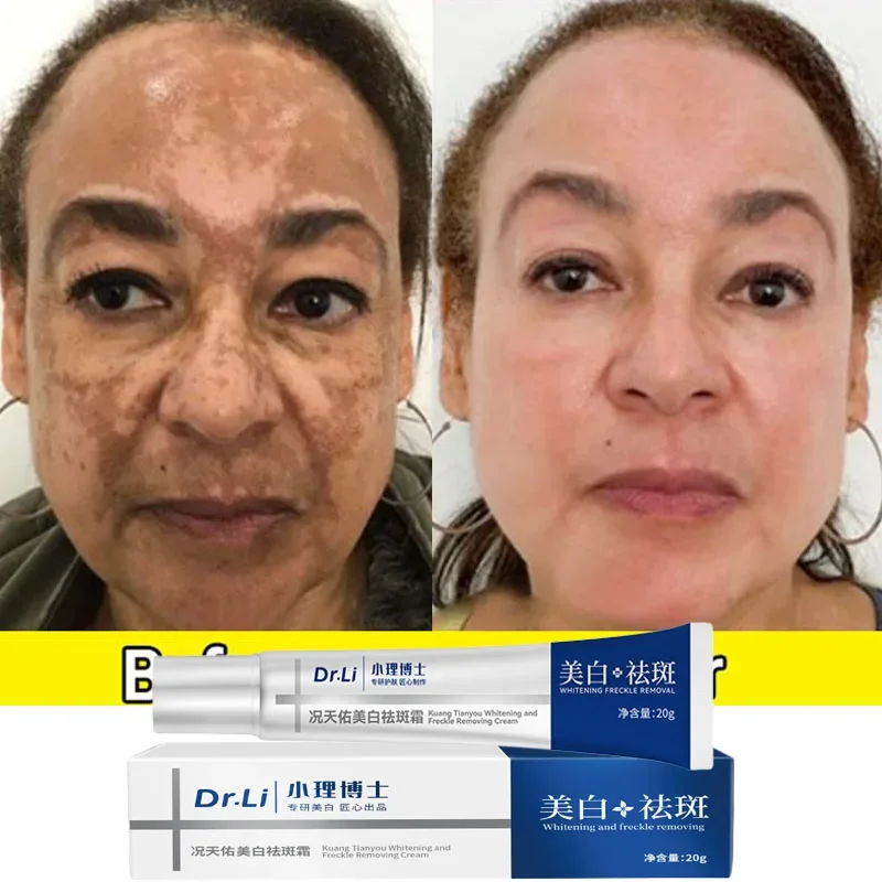 5PCS Effective Whitening Freckles Cream Remove Melasma Dark Spots Fade Pigmentation Moisturize Brighten Face Korean Skin Care