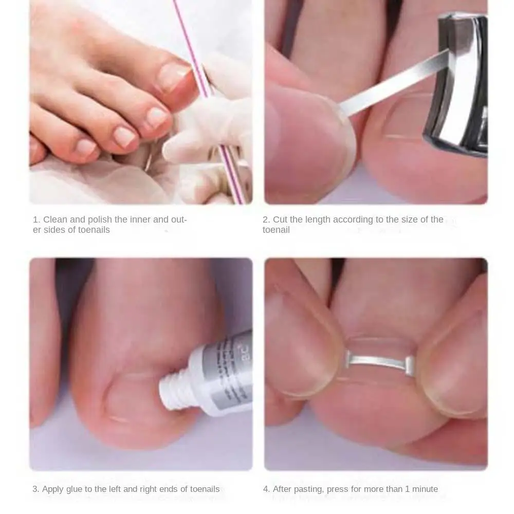Toenail Recover Pedicure Tool Toe Splint Support Toenail Straightener Toenail Fixer Bunion Corrector Ingrown Toenails Corrector