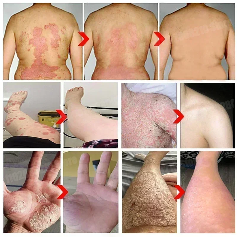 Рисунок 5 - Экзема от псориаза кожи подходит