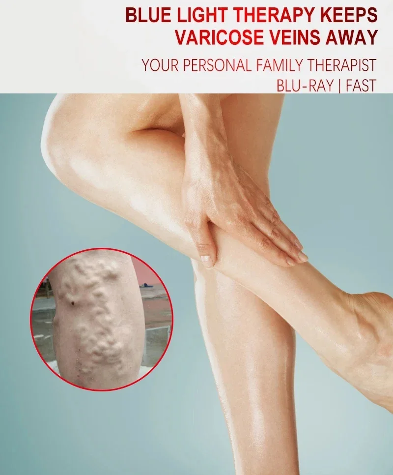 Laser Treatment for Phlebitis/Vasculitis | Anti-Swelling, Vein Bulge Pain & Circulation Aid