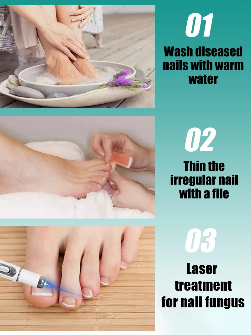 2025 Hot Sellers: Nail Cleaning Tools, Blue Light Laser Tools Root Repair Upgraded to Second Generation