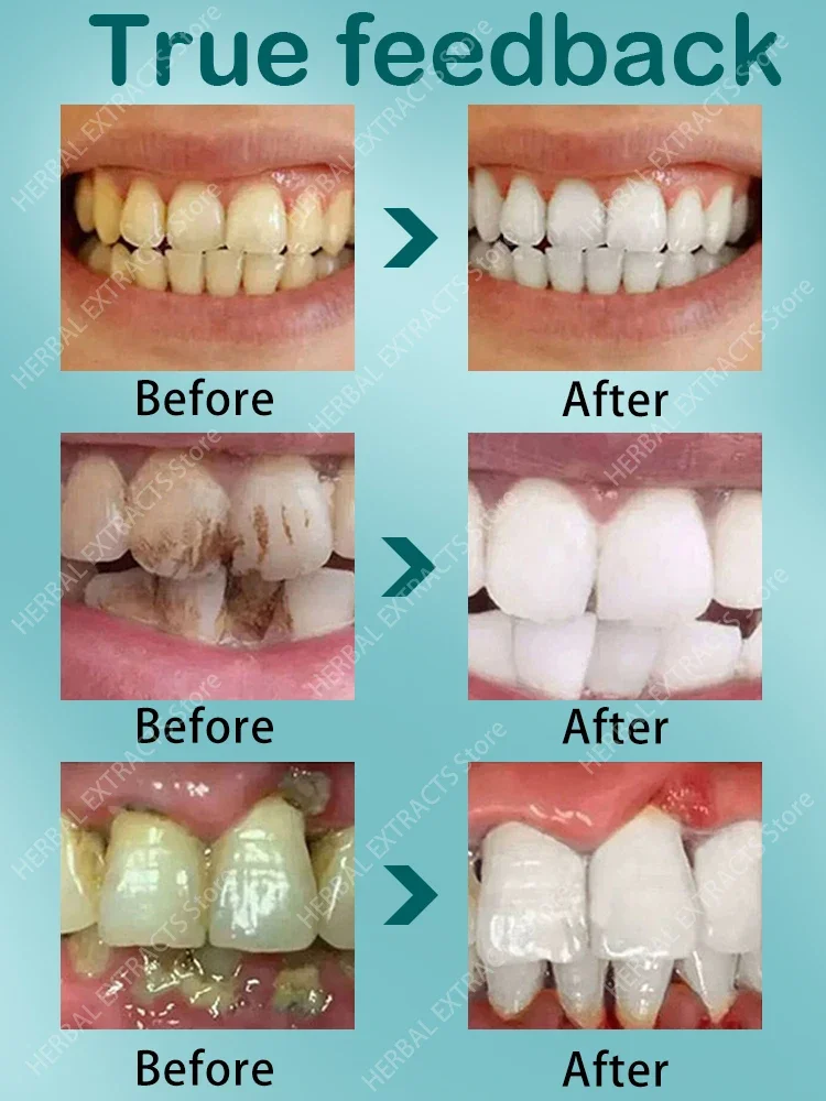 Quick And Deep Cleaning Of Teeth To Coffee Stains