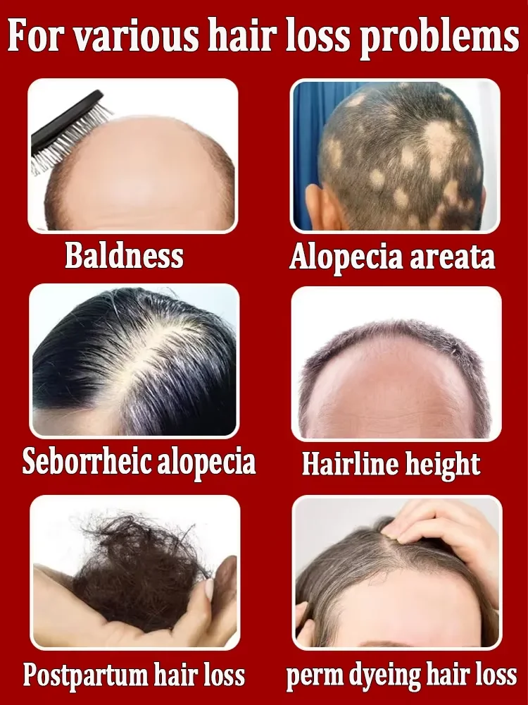 Densificazione dei capelli, crescita rapida, densificazione dei capellicrescita rapidadispositivo anti-stripping maschile e femminile