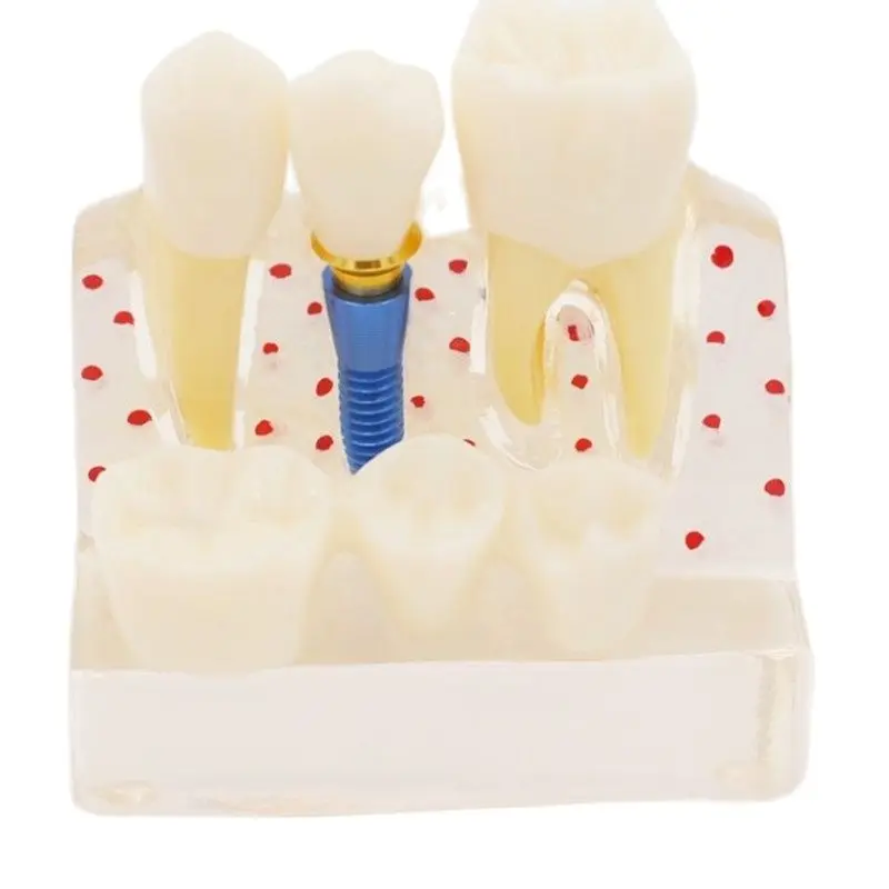 Dental Teach Implant Analysis Crown Bridge Removable Model Dental Demonstration Teeth Model