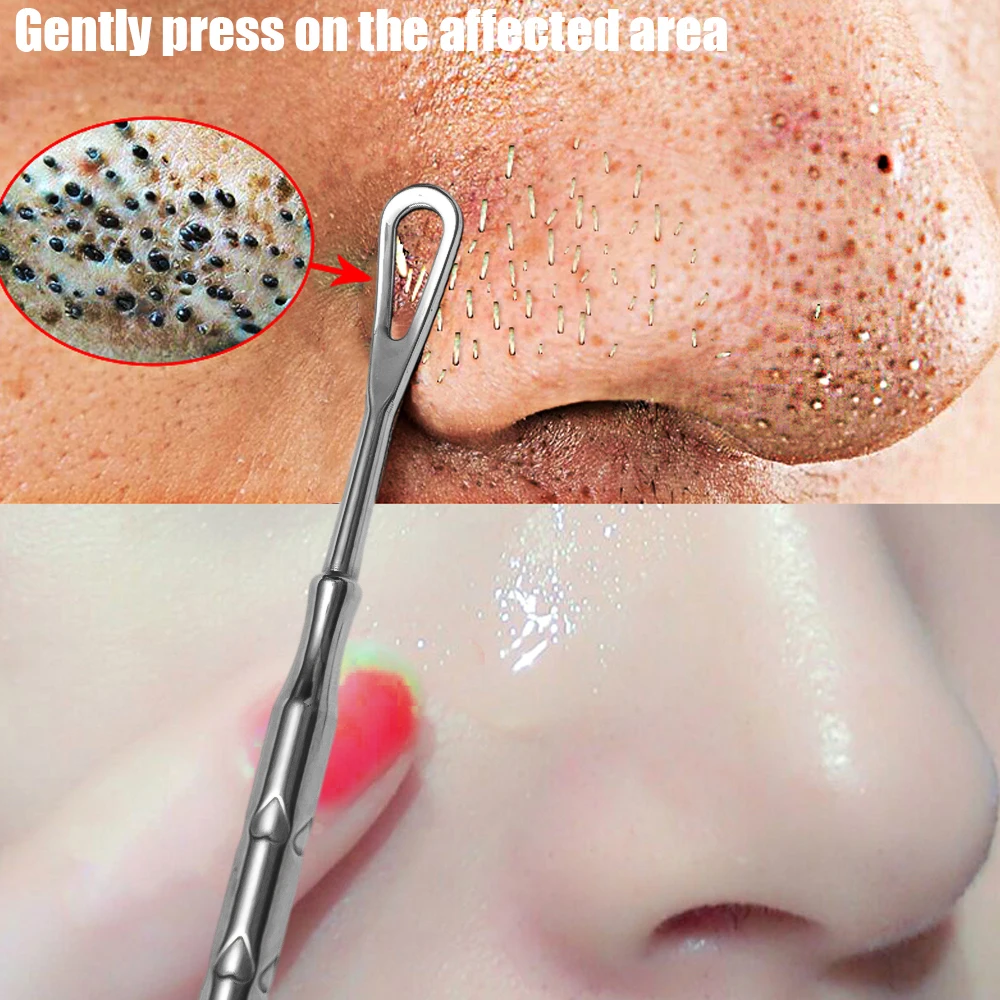 Blackhead Remover Pimple Popper Tool Acne Needle Removing Treatment Comedone Whitehead Popping Zit Nose Face Blemish Extractor