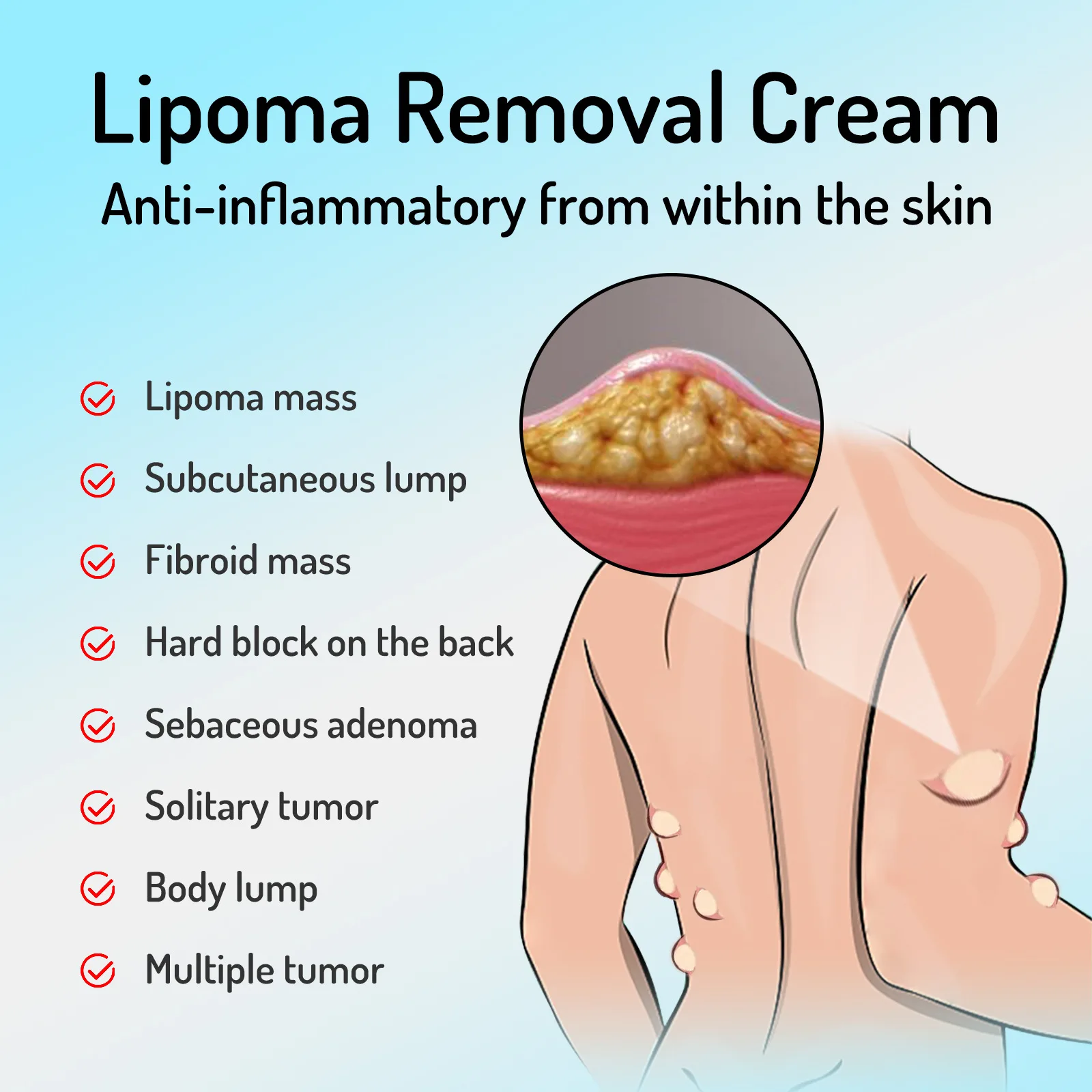 South Moon Lipoma Removal Cream Treatment Skin Swelling Lipolysis Fat Lump Cellulite Elimination Lump Nodule Smoothing Ointment