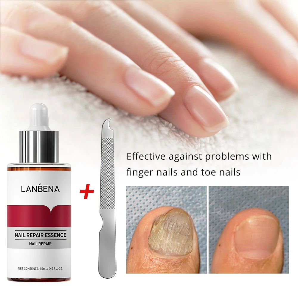 LANBENA soin des champignons supprimer l'onychomycose orteils nourrir éclaircir les mains pieds produit réparation approprié femmes ongles Pepair Essencs