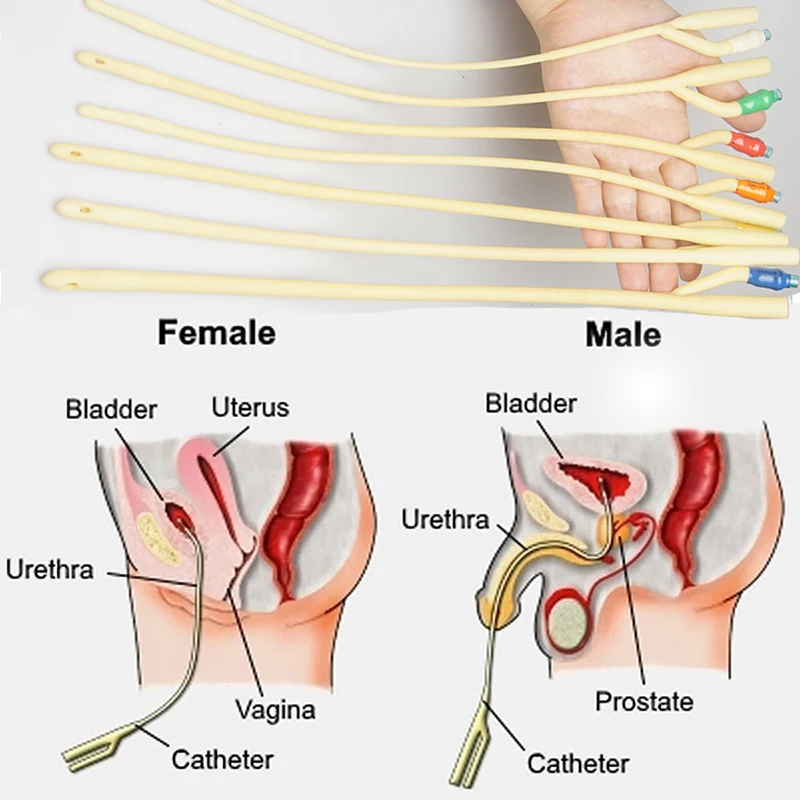 Dilatador de sonido para el pene, dilatador de la vejiga con sonido uretral, SONDA DE Uretra