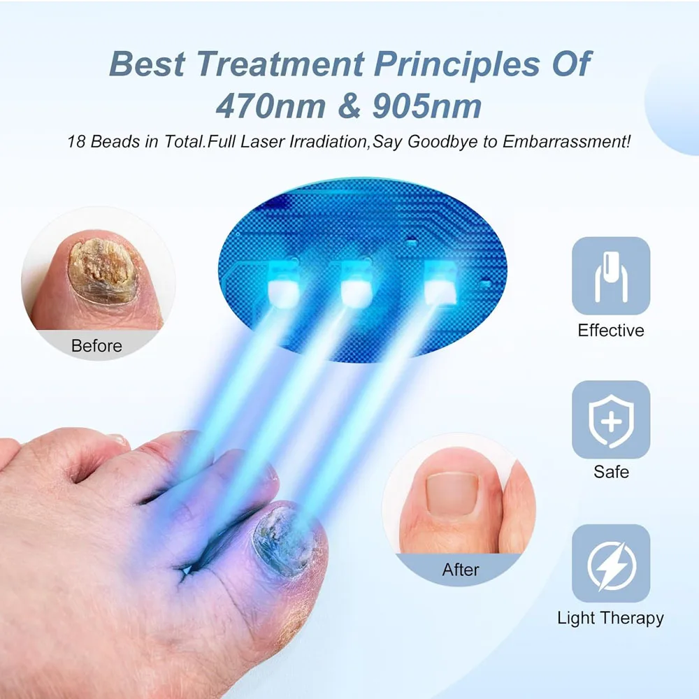 Toenail Fungal Nail Laser Treatment Repair Fast Nails Fungus Onychomycosis Repair Removes Foot Fingernail  Nail Fungus Device