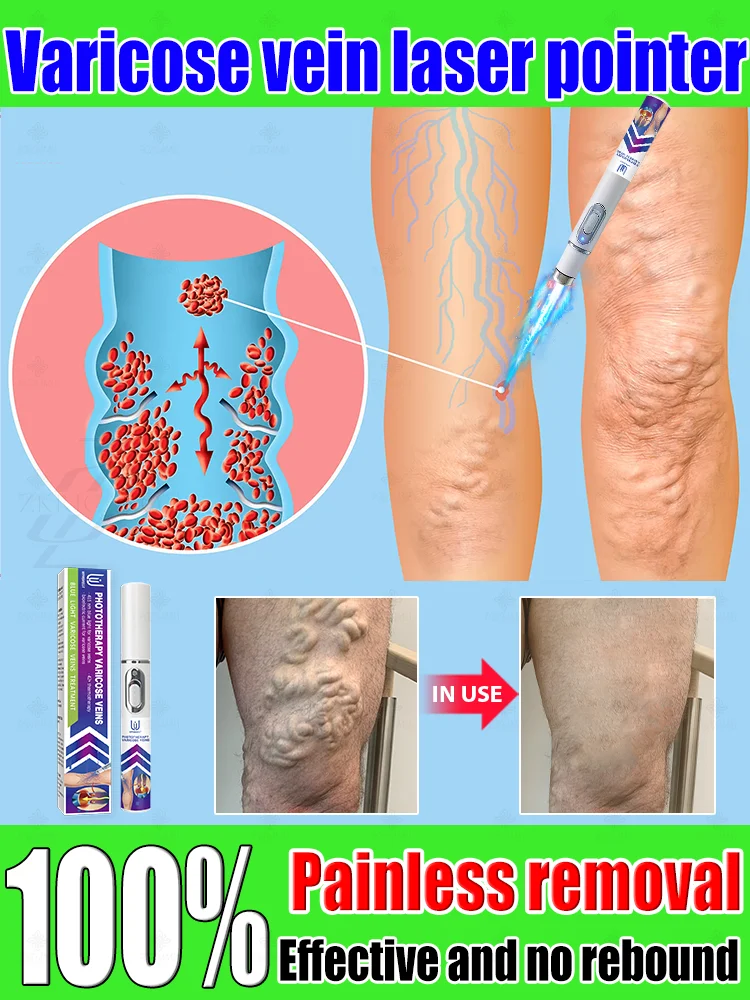 

Reverse leg health in 7 days and say goodbye to varicose vein recurrence