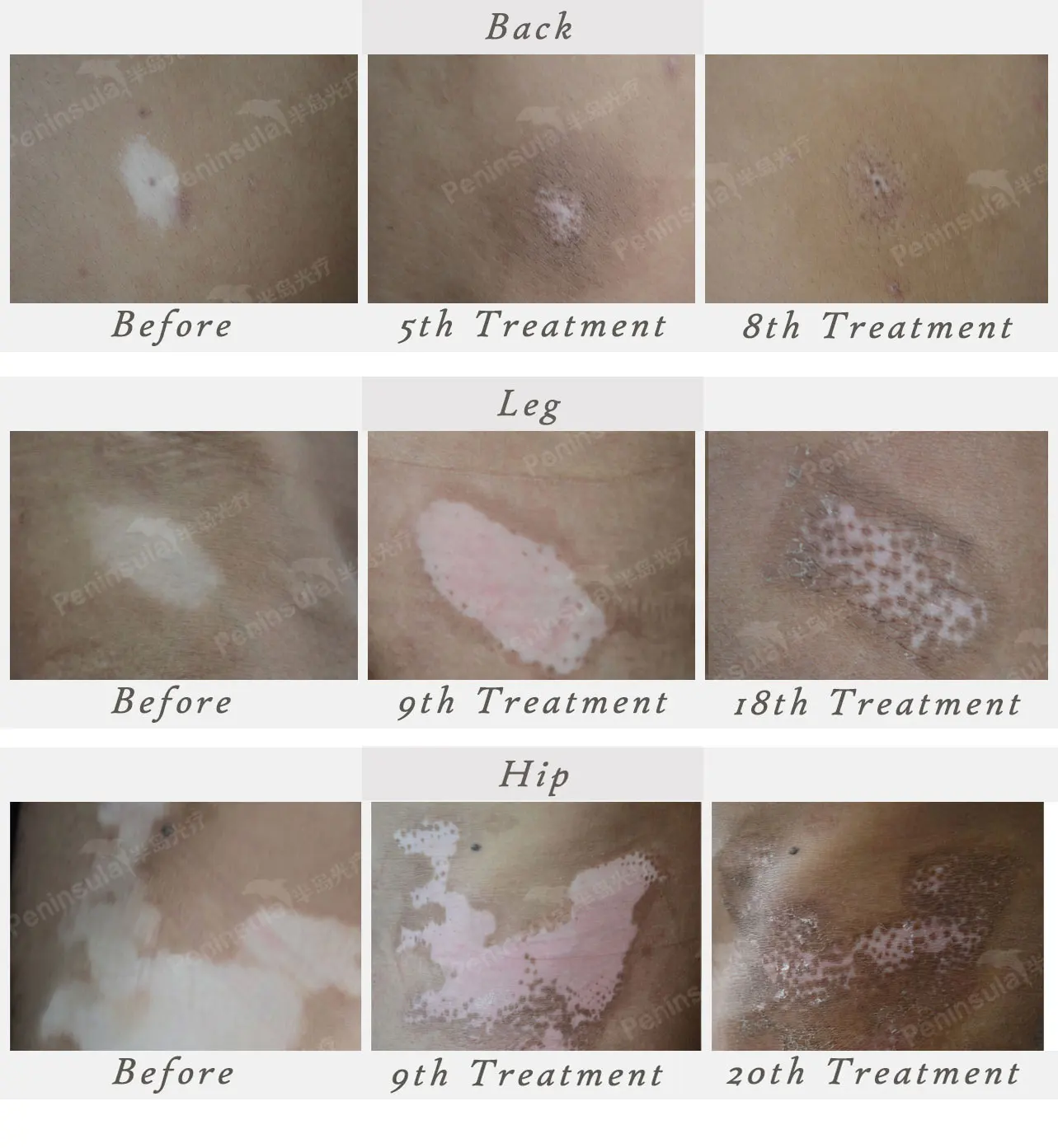 Peninsula phottherpy LED 311nm  Healthcare Pototherapy  Vitiligo UVB Lamp Vitiligo Psoriasis