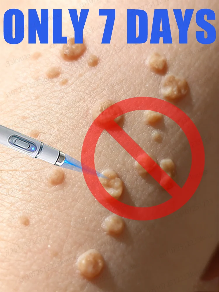 

Outil Wart Blue Light, plus de réductions sur les ensembles