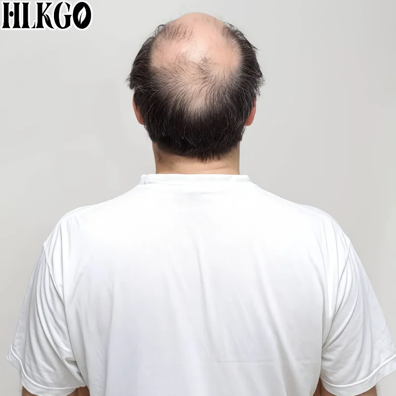 Clinical Grade 650nm LLLT Hair Growth Device, 300 Diodes Laser Helmet for Follicle Activation Alopecia Areata Scalp Care