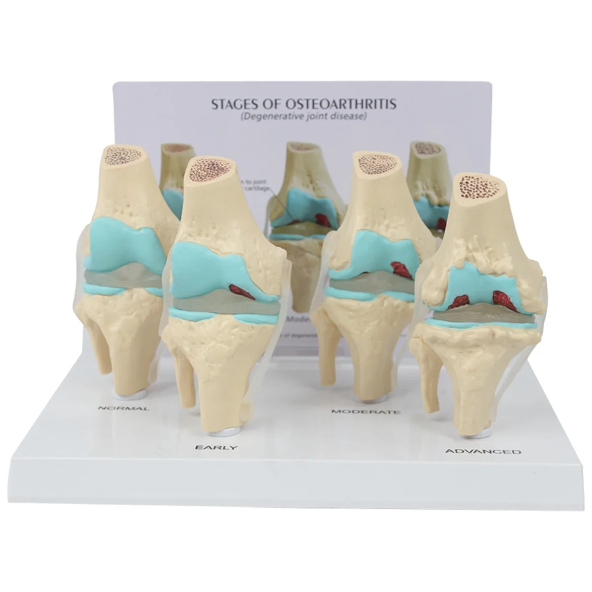 Kit de rodilla modelo de Anatomía de artritis con tarjeta de llave educativa, modelo de rodilla de 4 etapas, ayudas didácticas ortopédicas