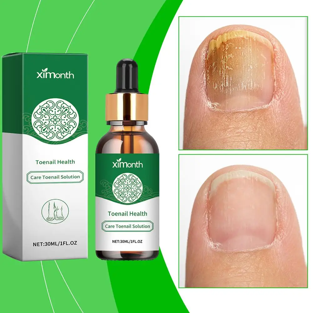 Nail Fungal Treatment Essence Oil, Foot Toe Serum, Reparação de onicomicose, Gel de infecção, remoção de fungos, B9W3, 30ml