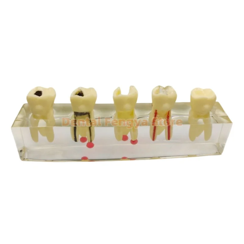 M4012 Dental Root Canal Pathological Development Demonstration Model Teeth Pathology Display Model Teaching / Training /Demo