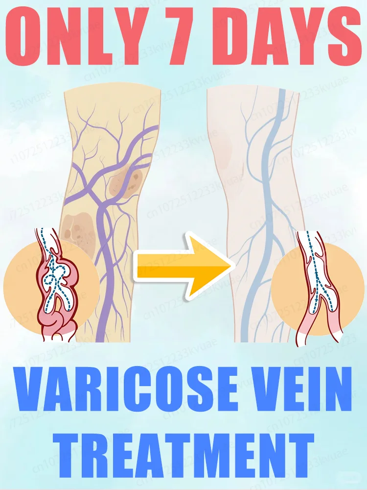 

blue light pen solve varicose veins, hot sale leg care tools