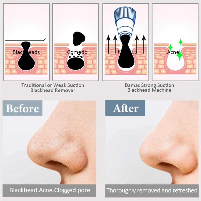Certified Heating Essence Introduction Cold Compresses Shrink Pores Vacuum Blackhead Extraction Pore Cleaner Rechargeable