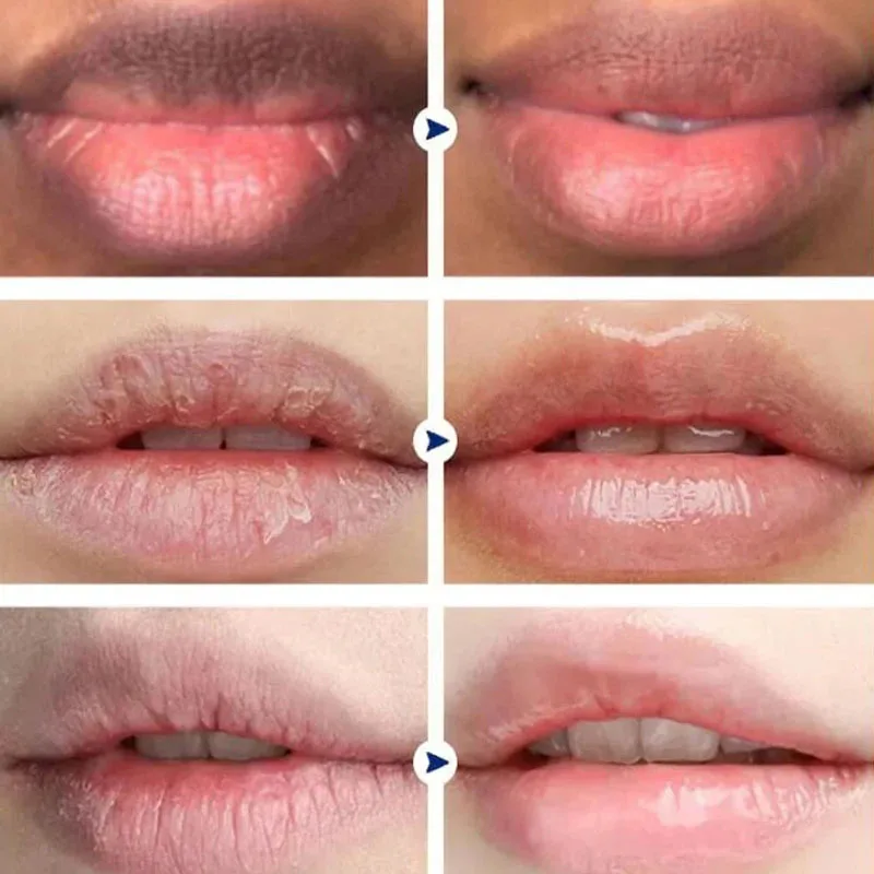 Lippen Roze Crème Verse Bleekbehandeling Verwijderen Donkere Rook Lippen Lippenbalsem Whitening Hydraterende Serum Verdunde Melanine Lipverzorging