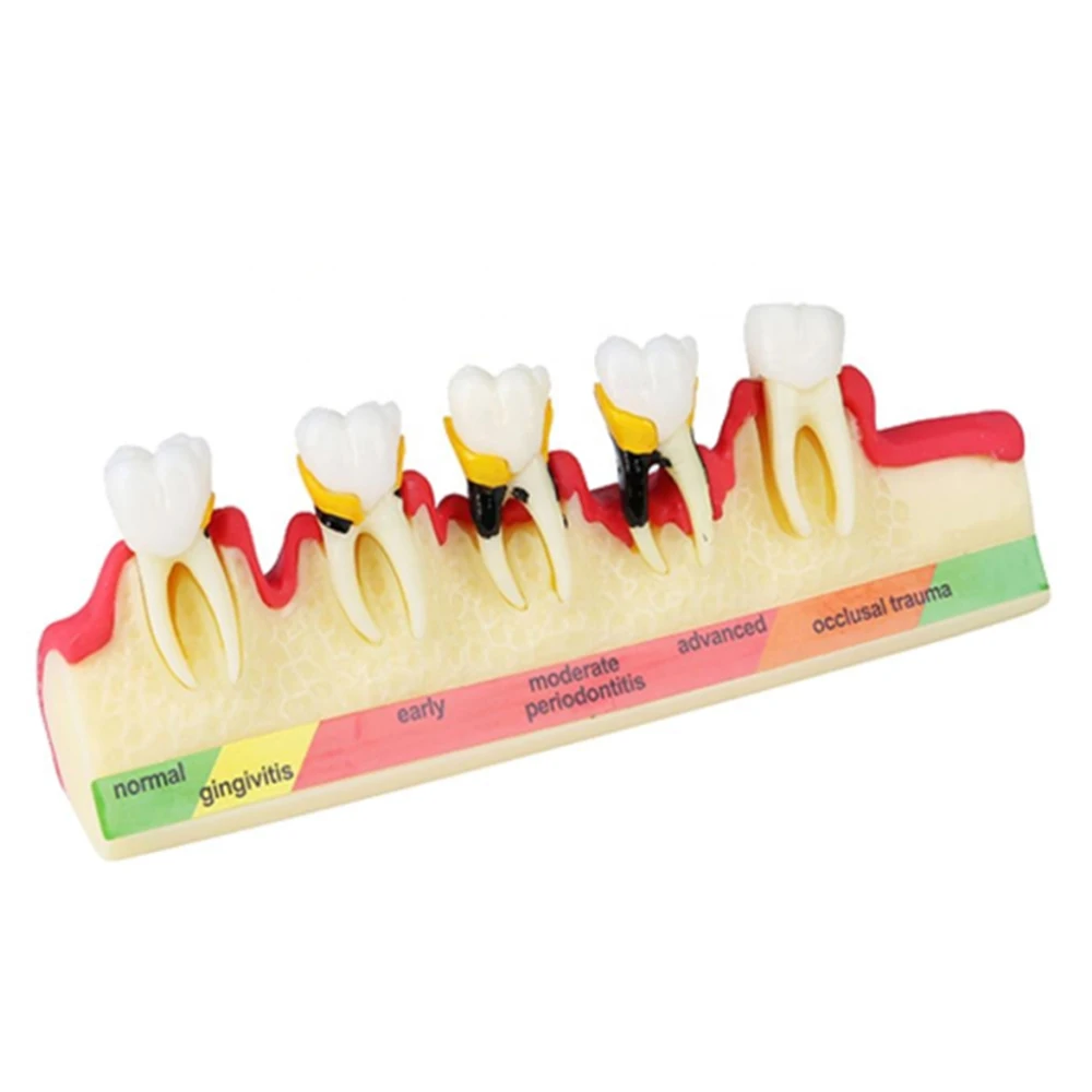 Model klasyfikacji chorób przyzębia dentystycznych Edukacja stomatologiczna Model zęba M4010 Model próchnicy zębów Klinika dentystyczna Zastosowanie