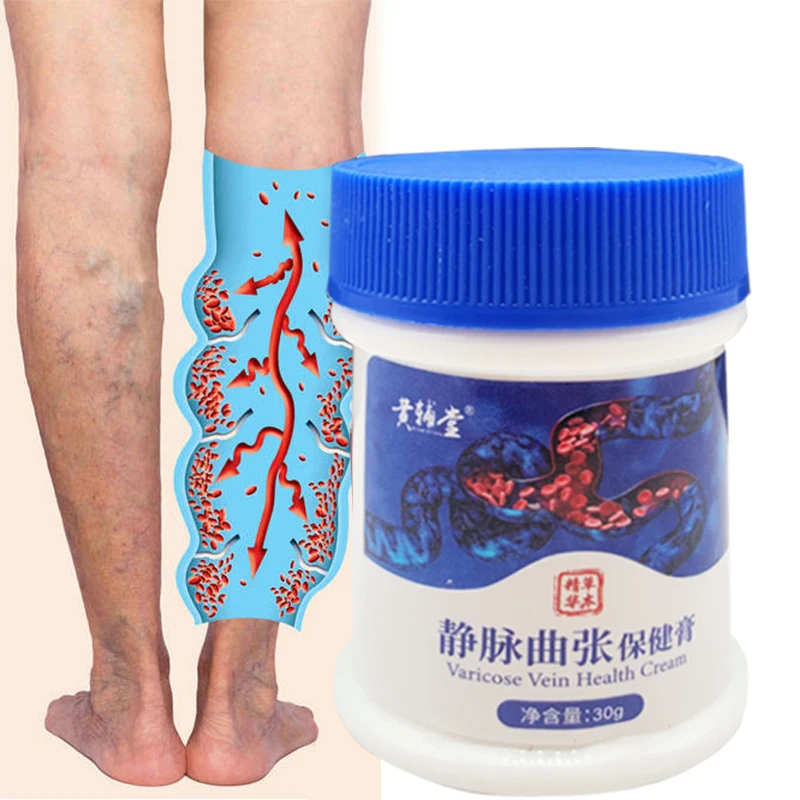 Varicose Veins Treatment Cream Effective cure Varicosity Angiitis ointment Health Care Vasculitis Phlebitis Spider Veins Pain