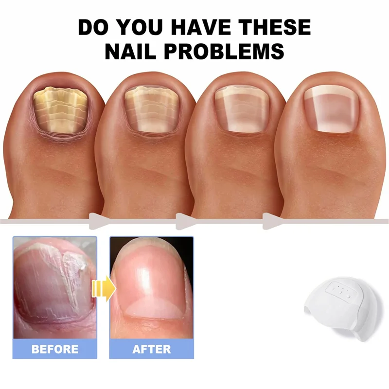 【SURPRISE】Fungal For Nail Treatment Device Lasers For Nail Fungus Onychomycosis Cleaning Foot Repair Fungi Removal Anti Mushroom