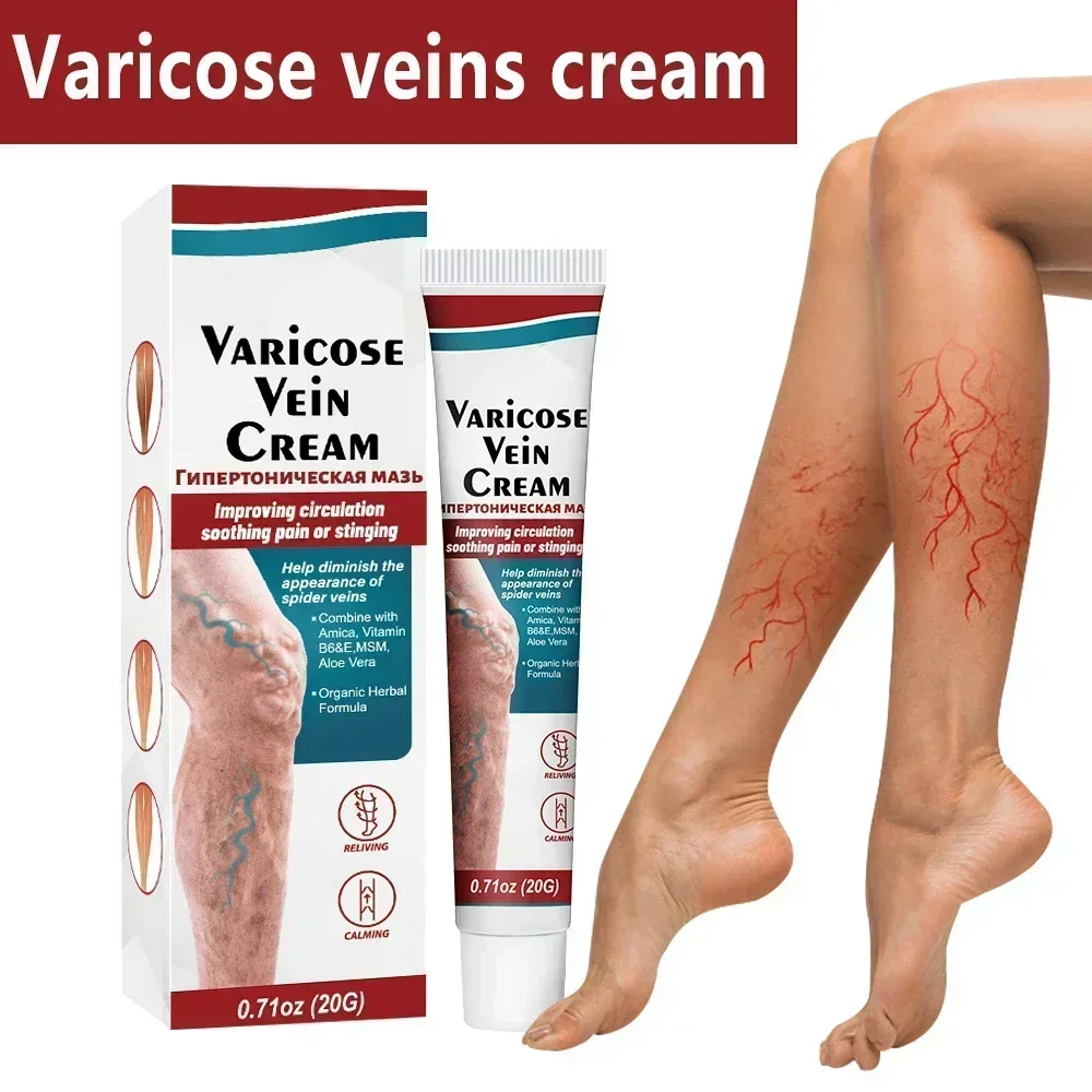 Crema de eliminación de venas varicosas, tratamiento efectivo para Vasculitis, gusano de tierra, Araña, reparación del dolor de piernas, pomada para aliviar la flebitis de yeso