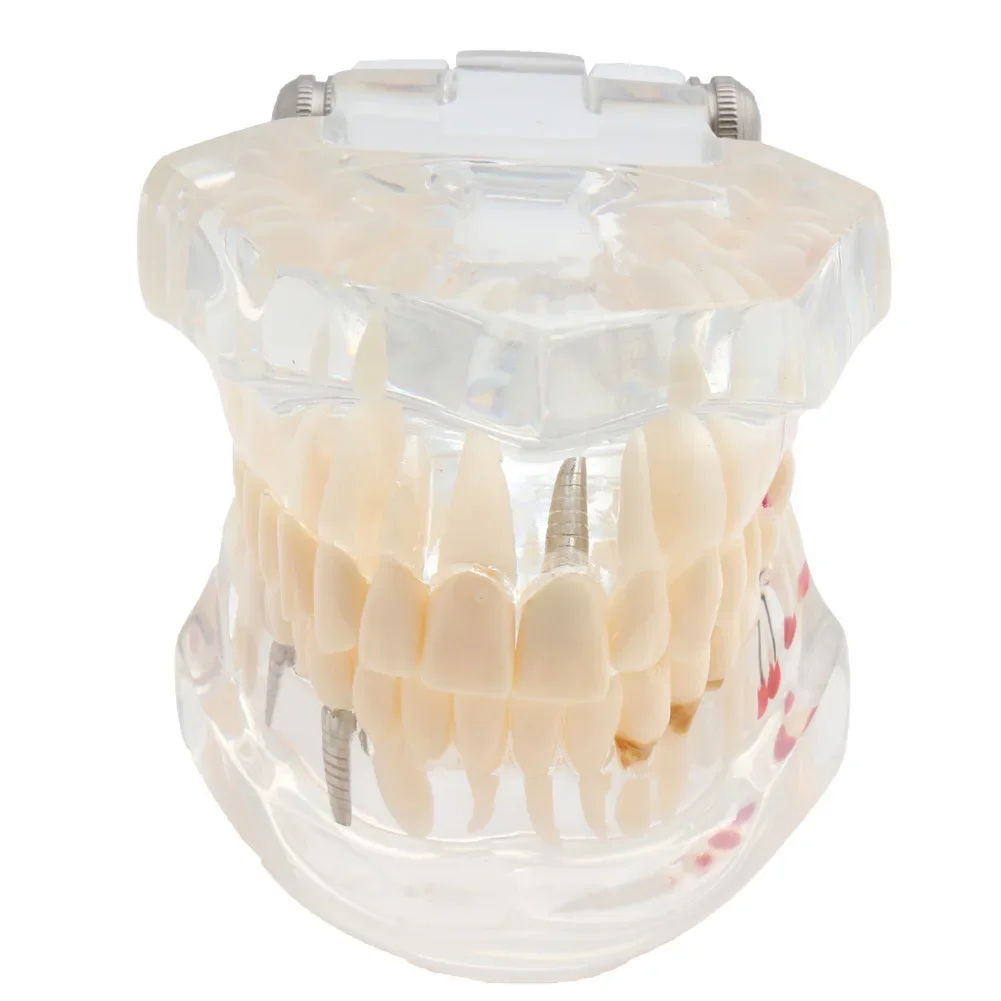 

Dental Teeth Model for Dental Technician Practice Training Studyting Oral Teaching Dental Detachable Prosthesis Dentistry Model