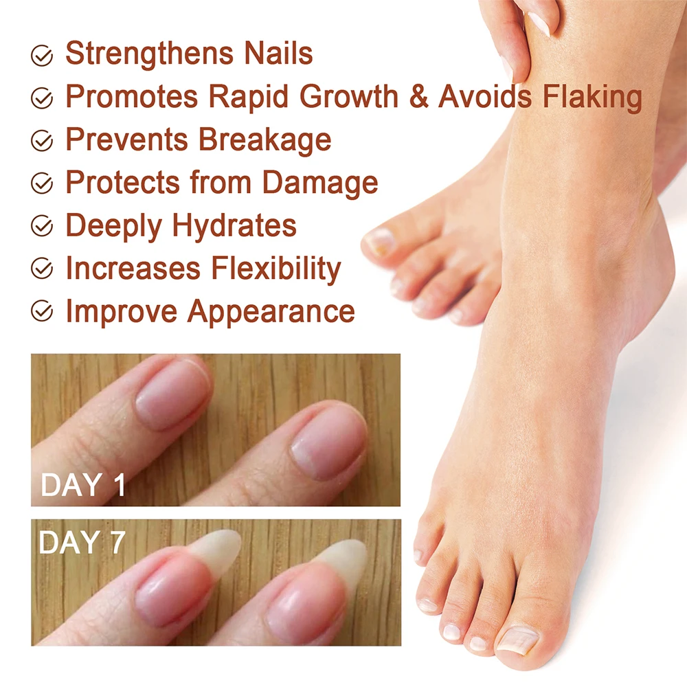 Nail Fungus Treatment Serum Toe Fungal Repair Products Hand Foot Care Removal Gel Anti Infection Onychomycosis Paronychia