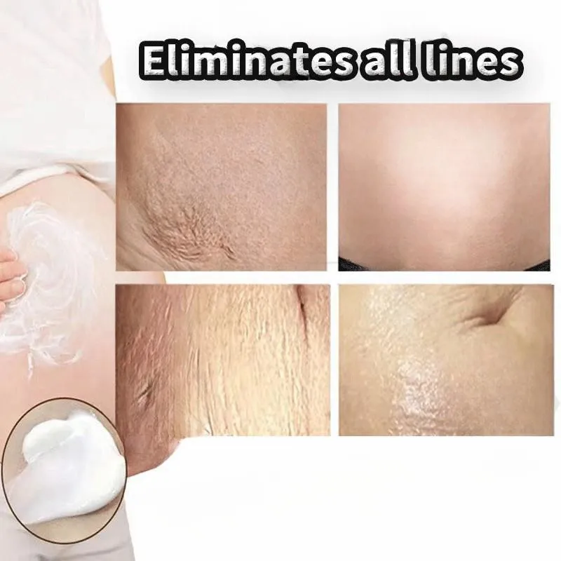 Creme de Remoção Permanente de Estrias, Eliminar Barriga Corporal, Túneis, Anti-Winkle Refirmante, Cuidados com a Pele, 7 Dias