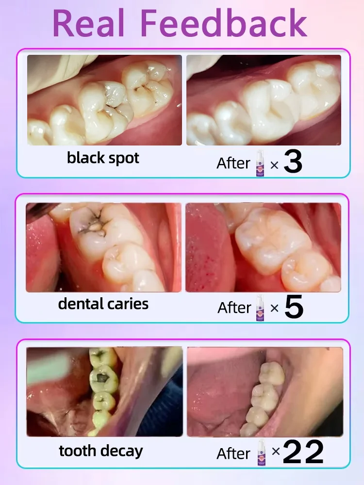 Diente de caries Caries curación anti caries