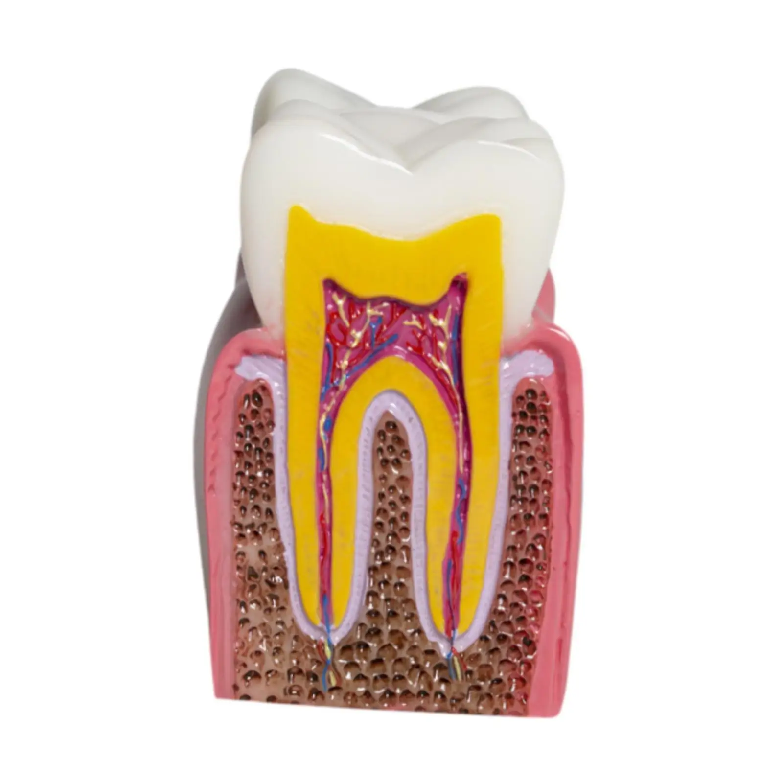 6 Times Caries Tooth Model Resin Dental Structure Teaching Aid for Early Childhood Education Family Learning and Classroom