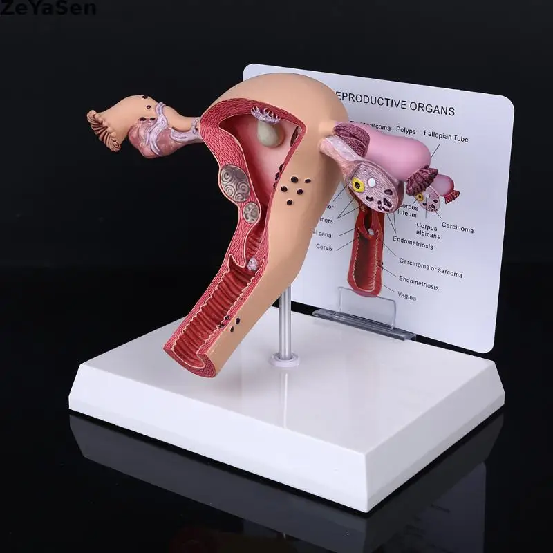 

Medical props model Human Female Pathological Uterus Ovary Model Anatomical Disease Pathology Medical Lesion ForBiology Teaching