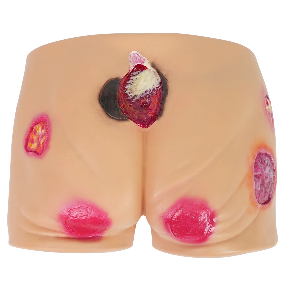 Buttock Ulcer Manikin Model Plastic PVC Multiple Wound Simulation Medical Wound Care Training Pressure Ulcer Education Nursing
