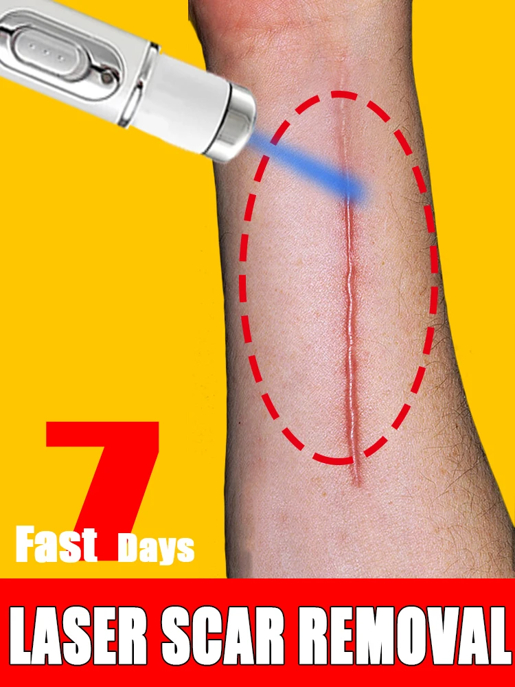 

Effective Scar LASER PEN，For all kinds of scars，Burn，Surgical scar，Various scars age