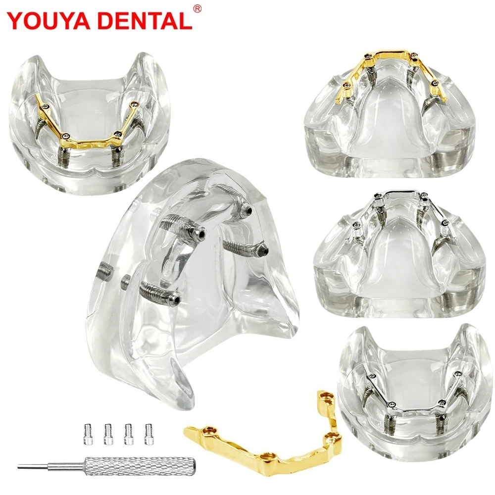 

Модель беззубых имплантатов, золотой/серебряный стержень, обучающая модель зубов с 4 имплантатами для студентов-стоматологии, практика обучения