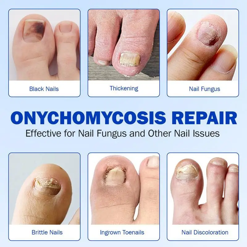 21 個足の爪パッチ柔軟な生地防水爪修理パッチ亀裂変色フットケア通気性陥入爪ステッカー