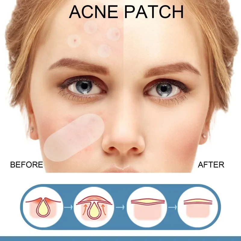 Atadura hidrocolóide para acne e cuidados com a pele, Removedor de manchas, cravo e Blemi Patch, 80 unidades por embalagem