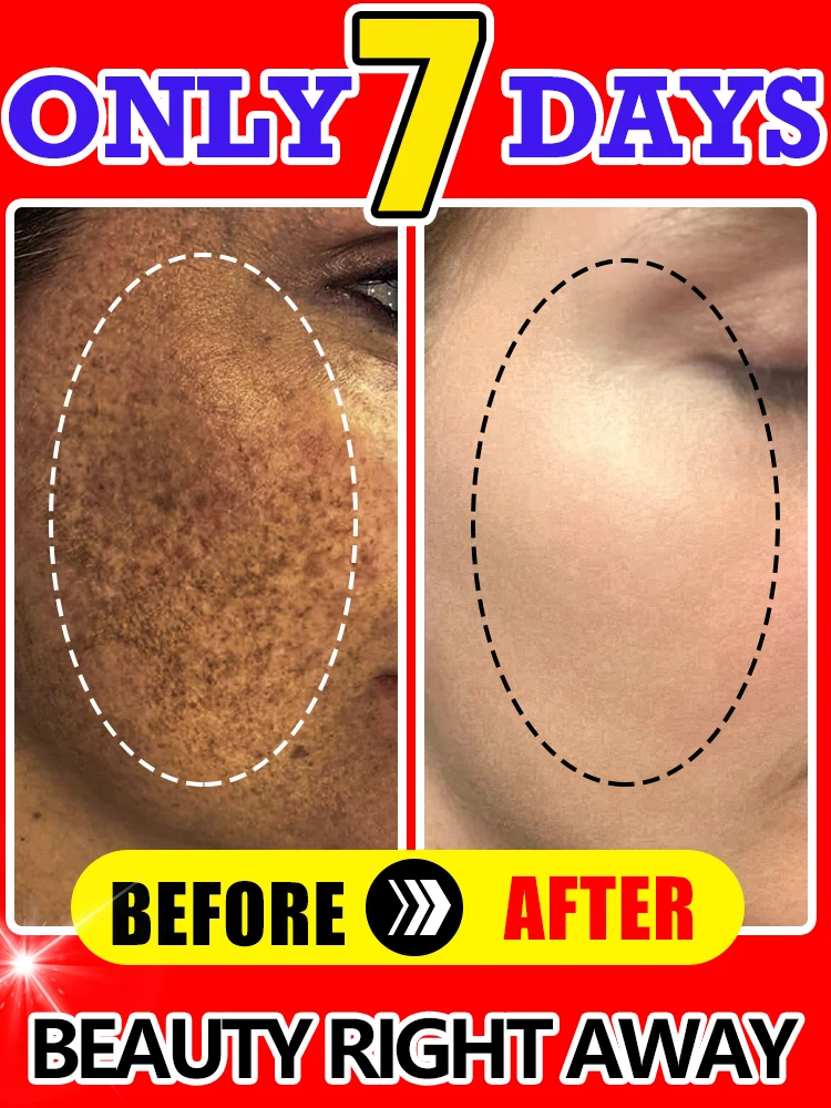 

Powerful Cream Fast Skin Lightening Solve Melasma Dark Spots