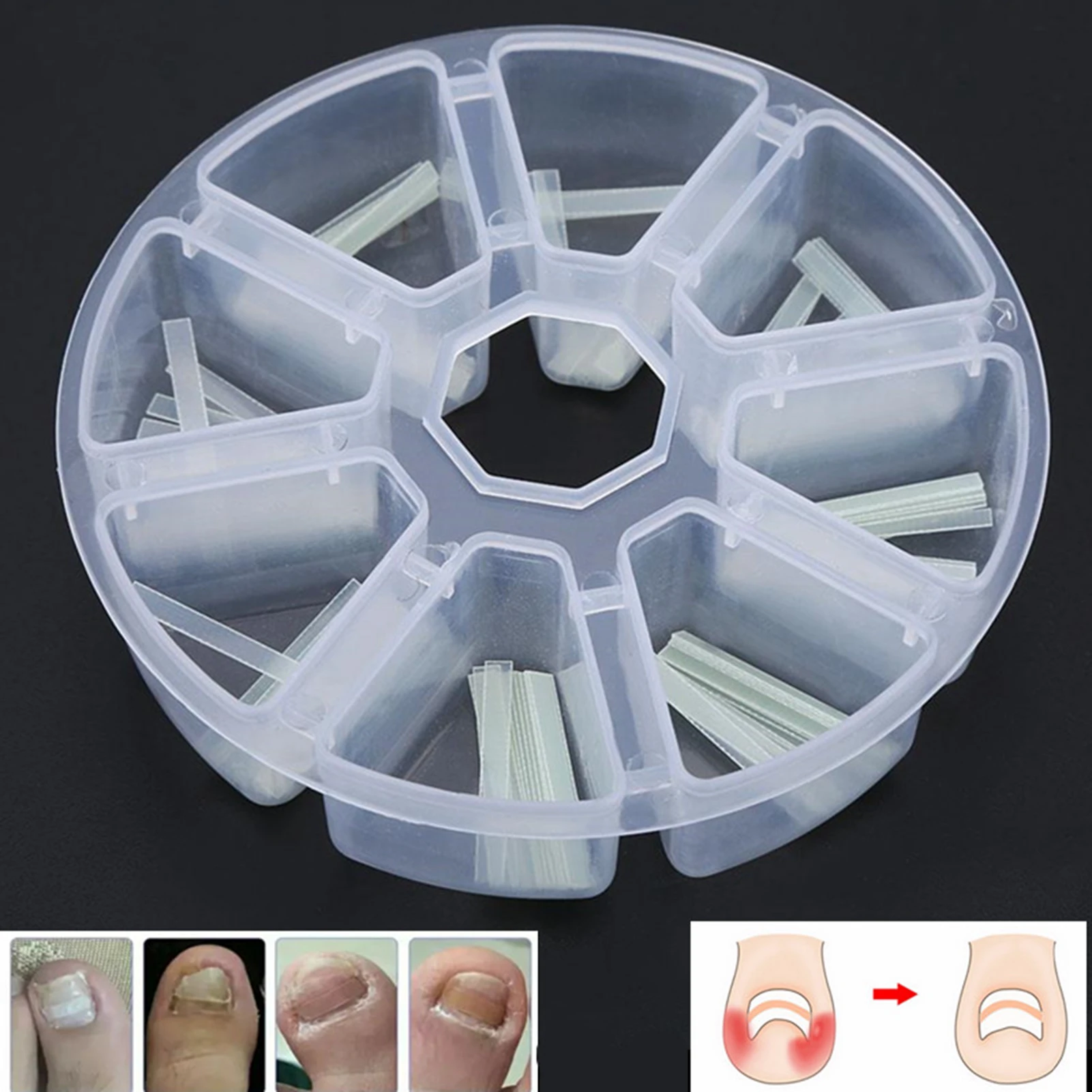 120 pièces/boîte autocollant incarné outil de soin des pieds pédicure incarné ongle redressage pince orteil autocollant pour ongles Patch outil de Correction
