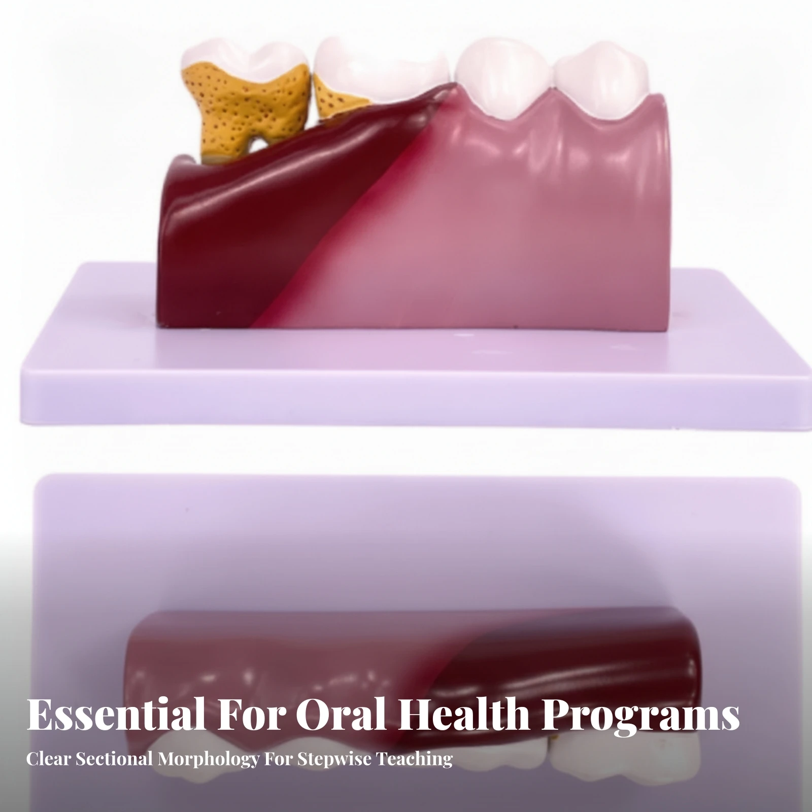 PVC Dental Pathology Model with Base 3D Visual Dental Caries Teaching Model Non Desktop for Classrooms, Study Sessions