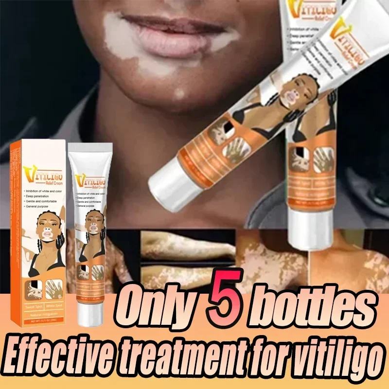 White Spot Cream for Vitiligo White Spots Leukoplakia Pigmentation Melanin Promoting Vitiligo Cream Skin Care